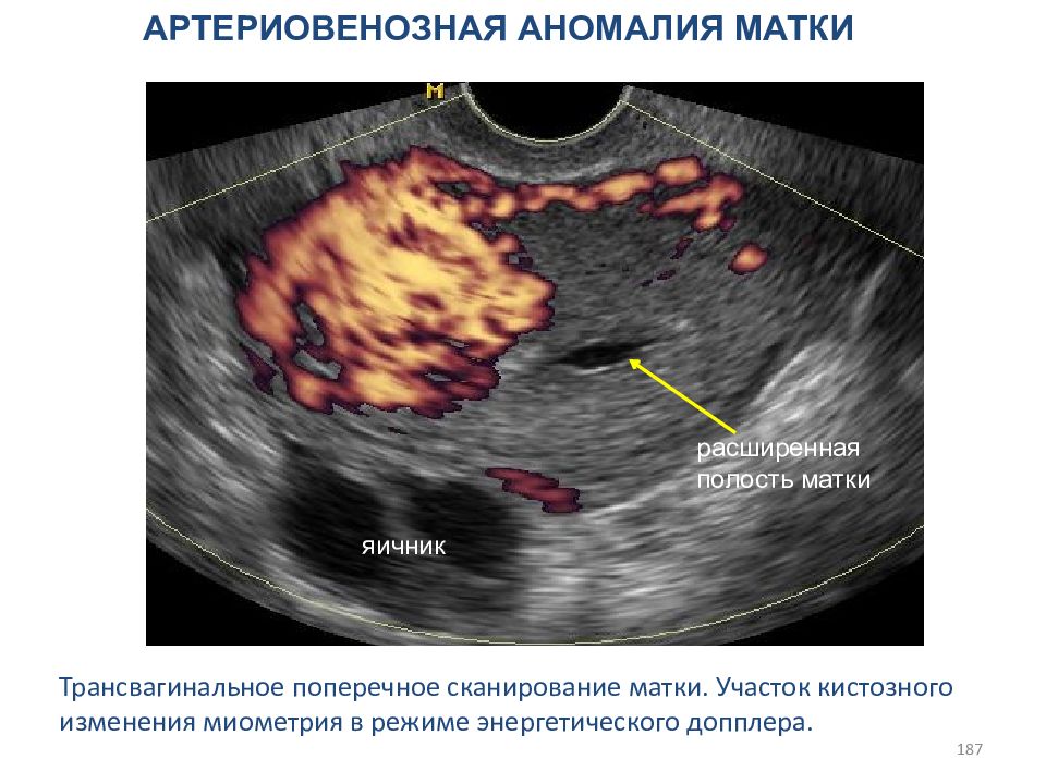 Расширение полости матки. Артериовенозная аномалия матки. Артериовенозная мальформация матки. Артериовенозная мальформация матки УЗИ. Мальформация матки на УЗИ.