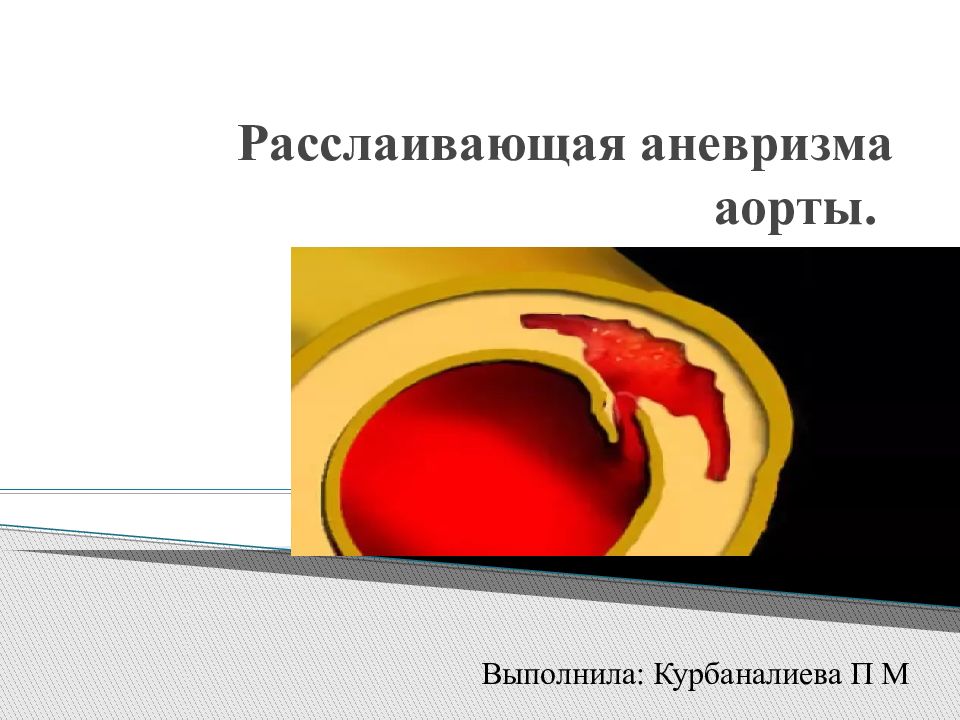 Расслаивающаяся аневризма аорты презентация