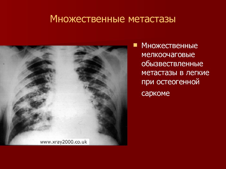 Метастазы это. Гематогенные метастазы в легких рентген. Множественные метастазы в легких. Метастазы в легких рентген.