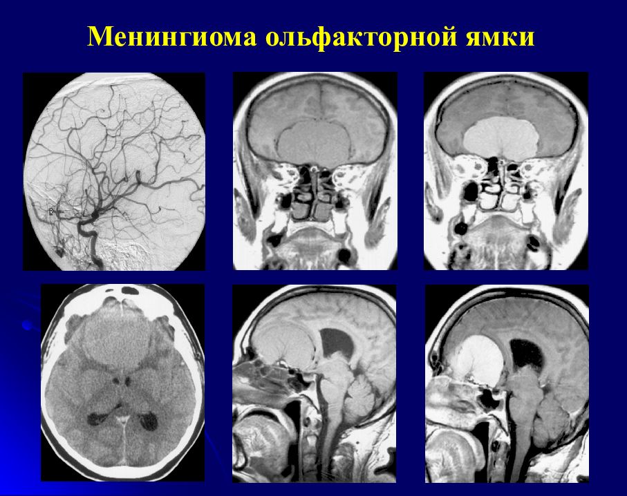 Менингиомы ольфакторной ямки