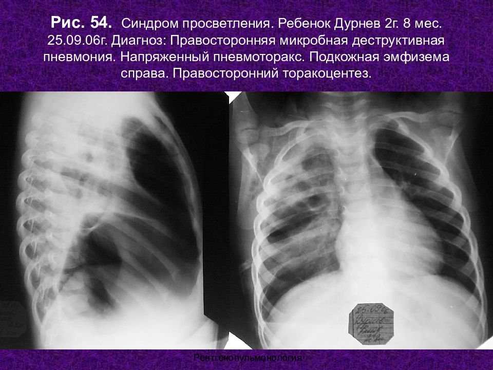 Рентген картина пневмоторакса