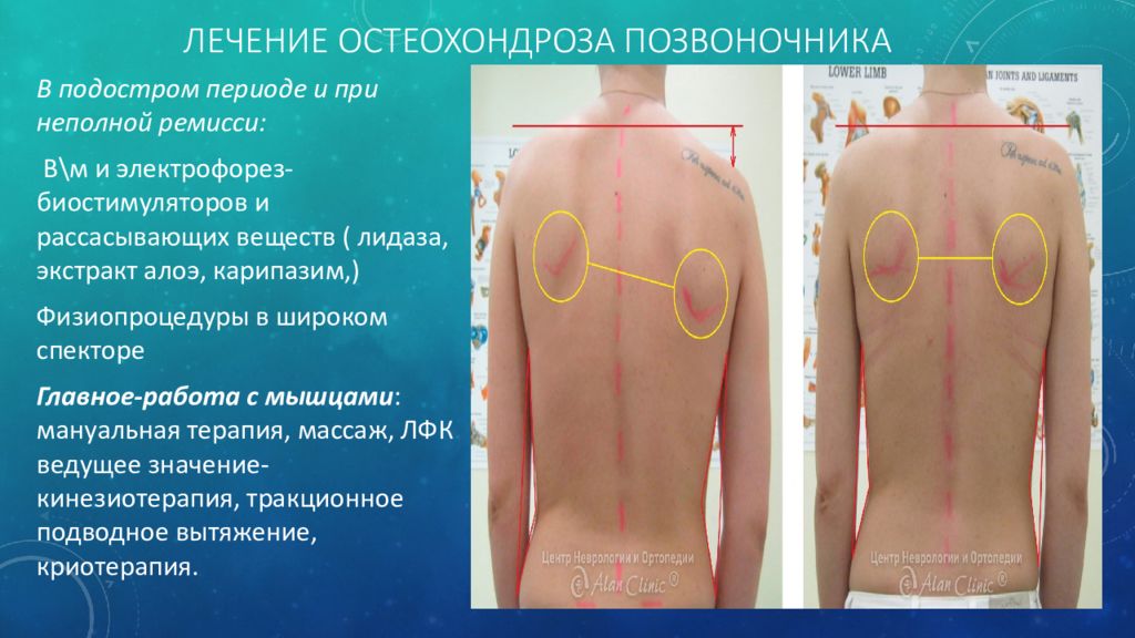 Простое лечение остеохондроза. Остеохондроз позвоночника. Остеохондроз позвоночника лечение. Йодная сетка на спине при остеохондрозе. Подострый период остеохондроза.