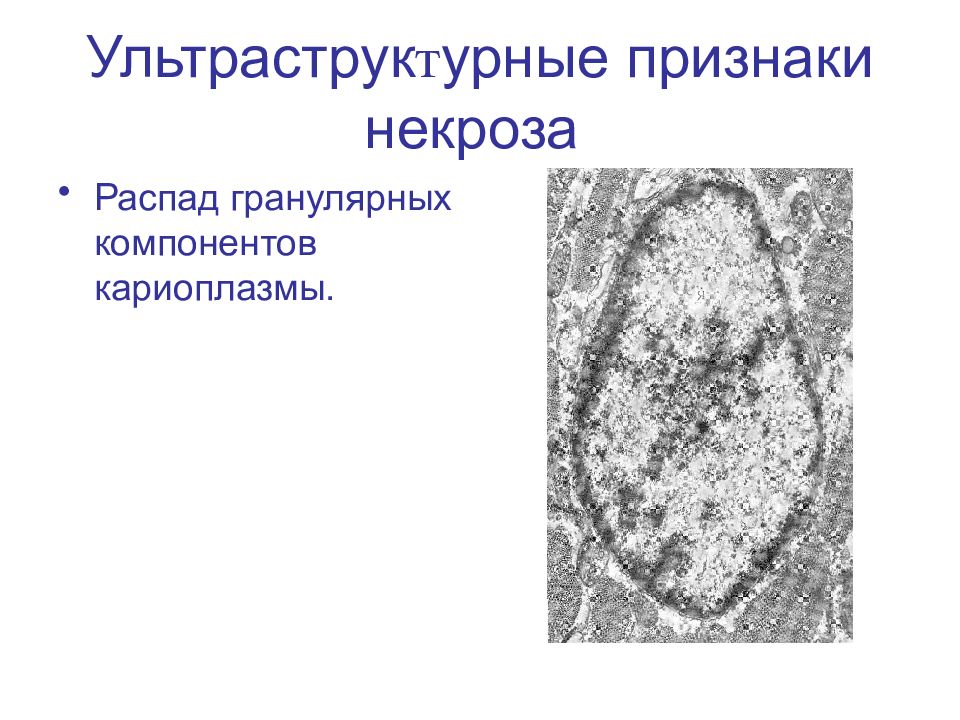 Признаки некроза. Ультраструктурные признаки некроза. Ультраструктурные изменения при некрозе. Гранулярный компонент.