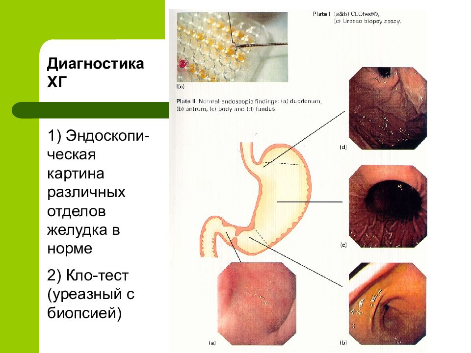 Хронические гастриты презентация