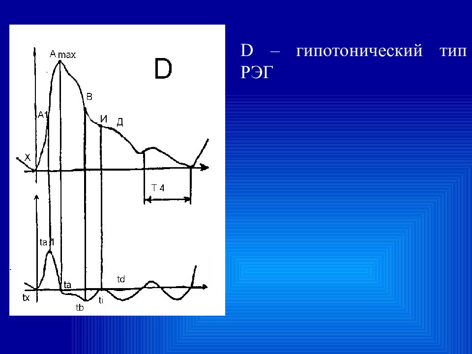 Физические основы реографии. Рэг при гипертонии. Гипертонический тип. Гипертонический тип рэг. Гипотонический тип рэг.