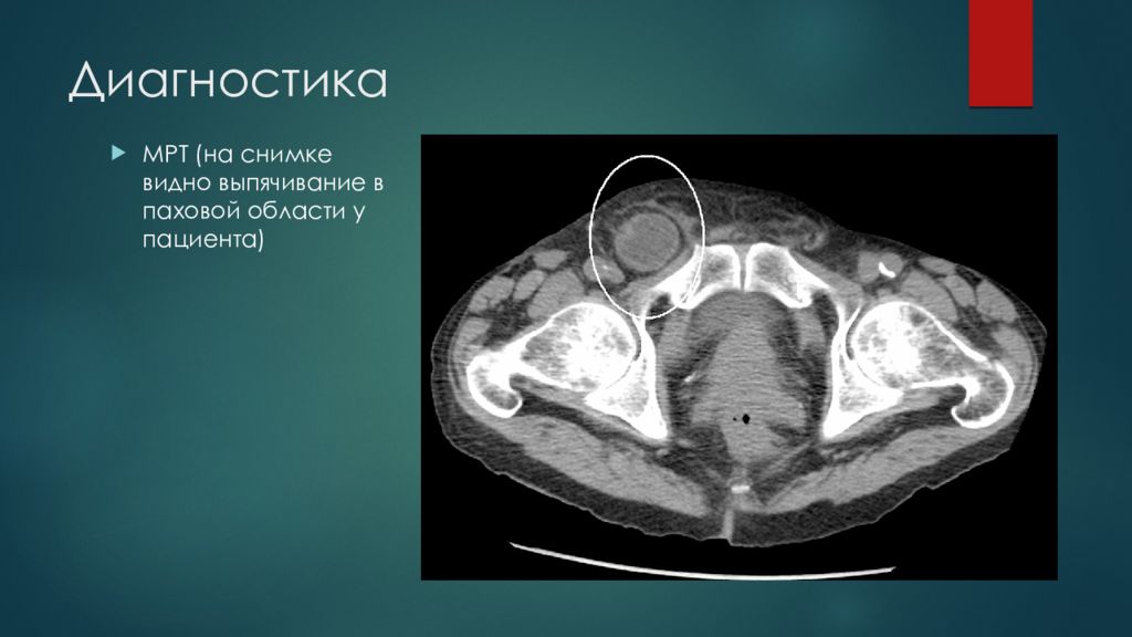 Грыжи малого таза. Образования передней брюшной стенки кт.