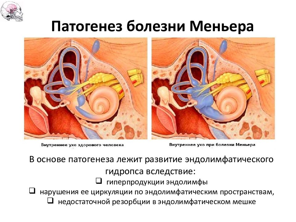 Внутреннее ухо тесты. Болезнь Меньера гидропс. Болезнь Меньера этиология. Болезни внутреннего уха Меньера. Болезнь Меньера эндолимфатический гидропс.