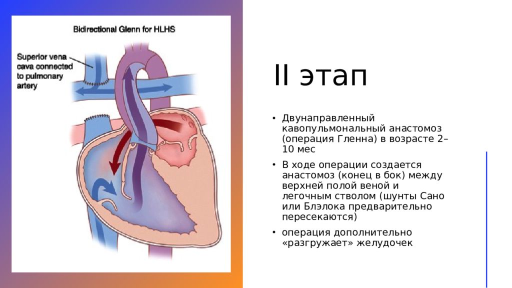 Левых отделов. Кавопульмональный анастомоз Гленна. Единственный желудочек сердца операция Фонтена. Двунаправленный кавапульмональный анастомоз.