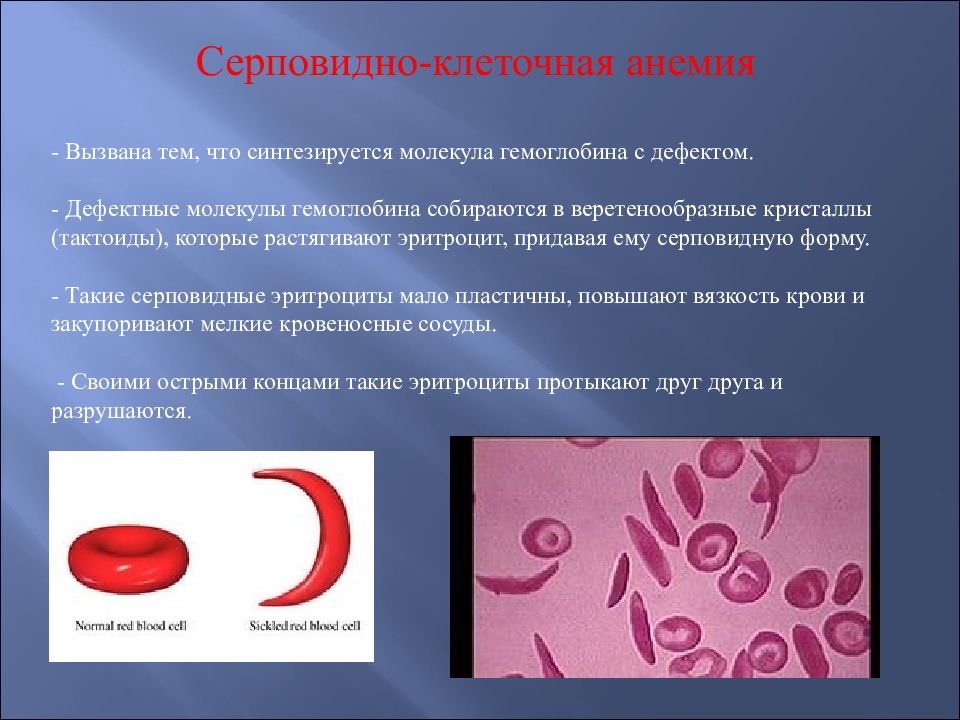 Малокровие вызвано. Серповидноклеточная анемия дефект. Серповидноклеточная анемия эритроциты форма. Серповидно-клеточная анемия (s-гемоглобинопатия). Серповидноклеточная анемия гемоглобин s.