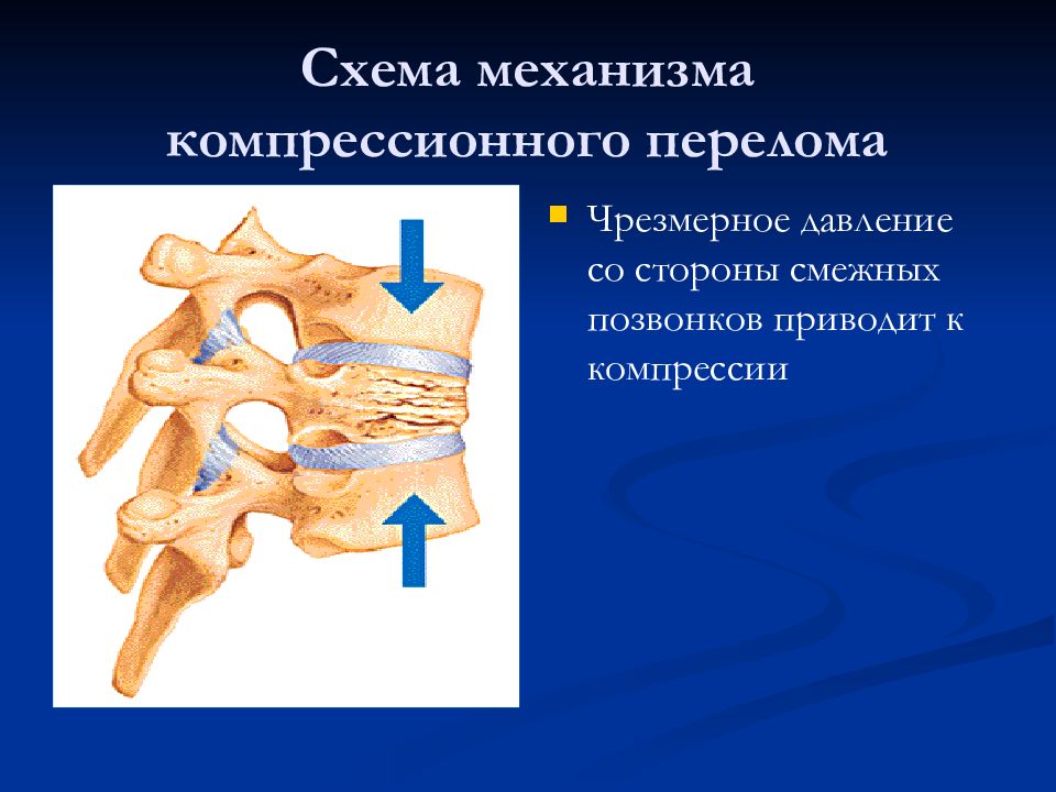 Компрессионный позвонка. Компрессионный перелом. Компрессионные переломы позвонков кт. Компрессионный перелом позвоночника кт. Компрессионный перелом позвонка кт.