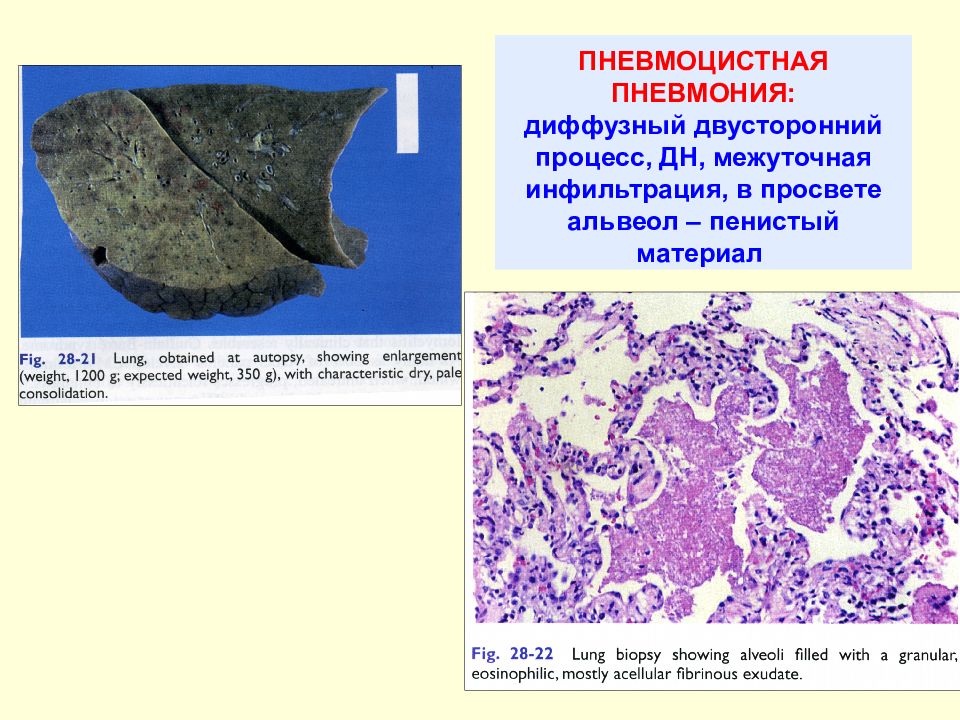 Вич патологическая анатомия презентация