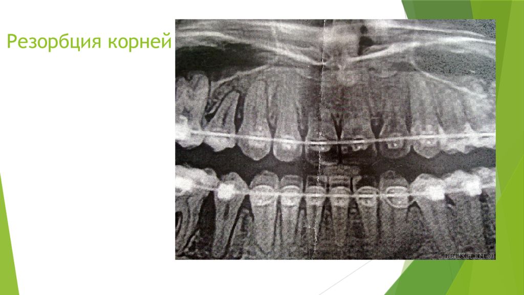 Рассосался корень зуба. Резорбция корня зуба на рентгене. Наружная апикальная резорбция корня.